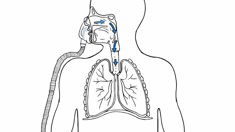 科普慢阻肺患者使用呼吸机能否让呼吸变得轻松